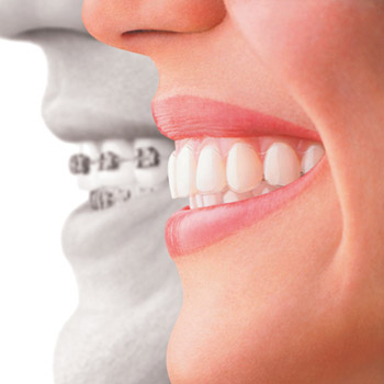 Invisalign®: How it Works