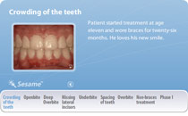 Common Orthodontics Treatments