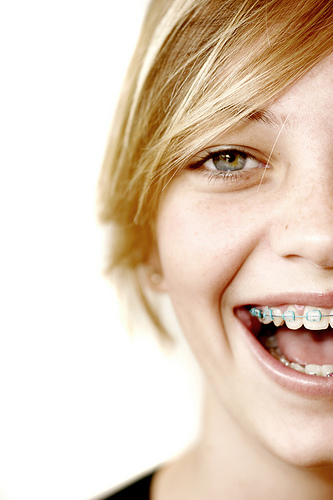 Fitting Braces into Your Life